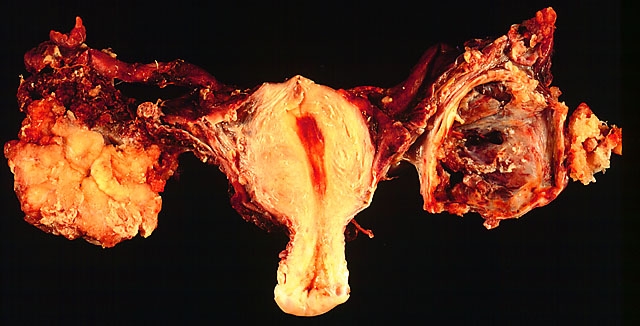 Carcinomul ovarian